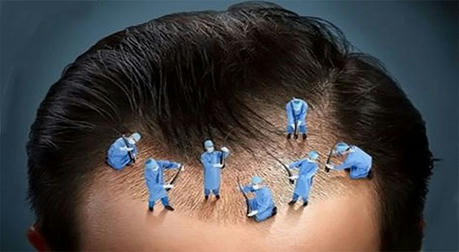 Common Misconceptions About Hair Transplantation:Five Myths You Should Know