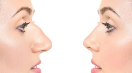 Information You Must Know About Rhinoplasty