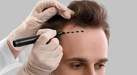 Common Problems In Hair Transplantation Surgery